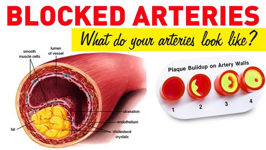 Unclog Arteries Fast